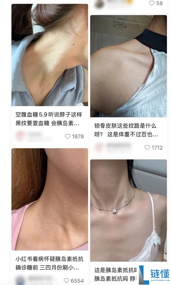 真的想问：脖子上一条条的“黑道道” 是胰岛素抵当吗