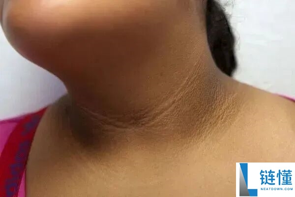 真的想问：脖子上一条条的“黑道道” 是胰岛素抵当吗