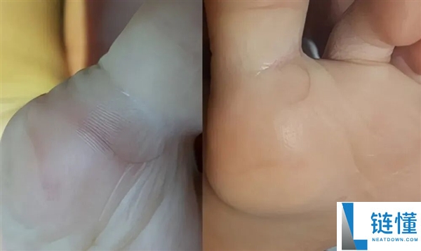 真的想问：脖子上一条条的“黑道道” 是胰岛素抵当吗