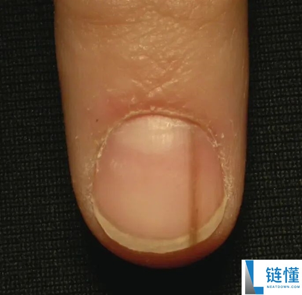 真的想问：脖子上一条条的“黑道道” 是胰岛素抵当吗