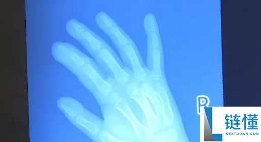 湖南5岁男童啃手致重度感染侵骨 大夫：小心引发脓毒血症