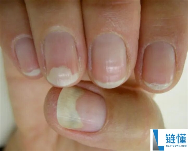 指甲为什么总从这个处所断开 是缺钙了吗