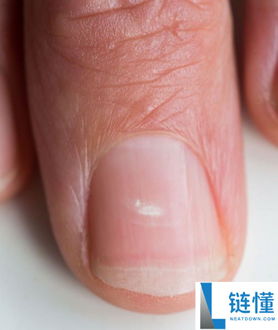 指甲为什么总从这个处所断开 是缺钙了吗
