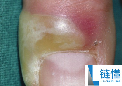 指甲为什么总从这个处所断开 是缺钙了吗