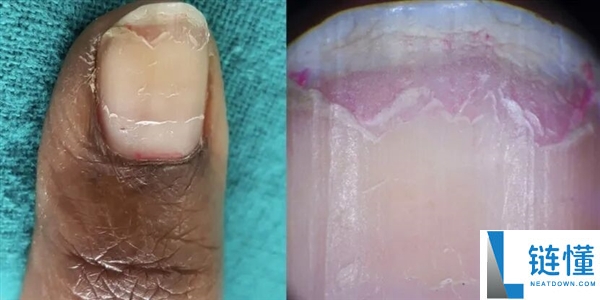 指甲为什么总从这个处所断开 是缺钙了吗