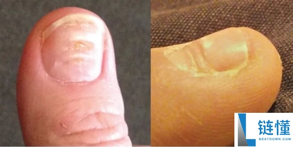 指甲为什么总从这个处所断开 是缺钙了吗