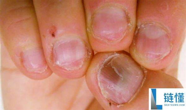 指甲为什么总从这个处所断开 是缺钙了吗