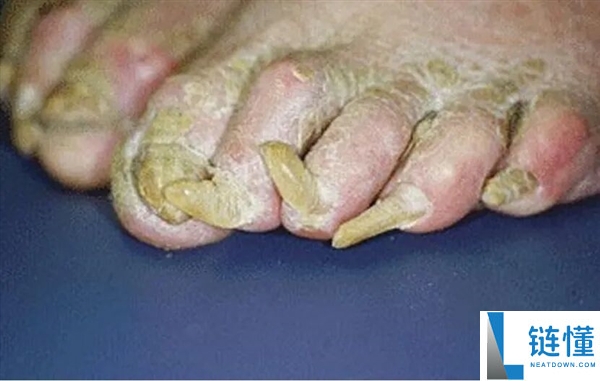 指甲为什么总从这个处所断开 是缺钙了吗