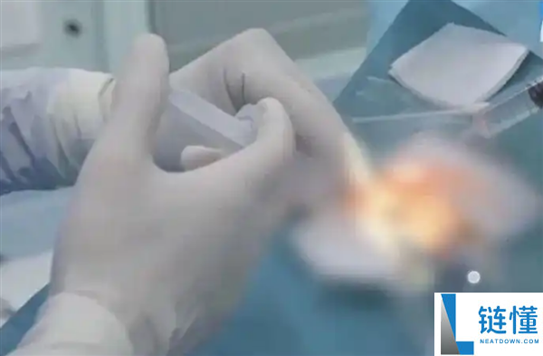 38岁男子宅家熬夜刷手机 眼压飙升引发青光眼险失明