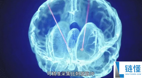 广西成功展开首例脑机接口手术：帕金森患者将完成生涯自理,