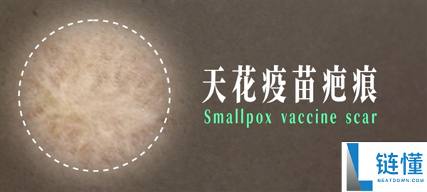 小时辰打过的疫苗：背地是一场逾越几代人的公共卫生战争