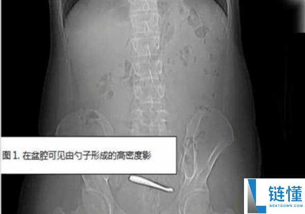 瞠目结舌：南京一小伙腹痛CT查出肠道卡2把勺子 婉言吞下时没发觉