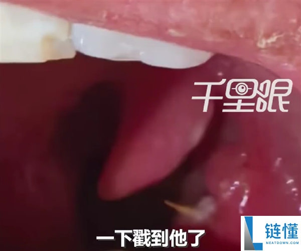 男人竹签卡喉误认为刀片嗓：吃8天药越吃越严重