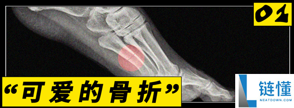 白女集体骨折真相揭秘：近期突发原因深度解析