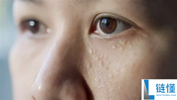 眼睛周围长小颗粒是什么？揭秘脂肪粒、粟丘疹成因与去除方法