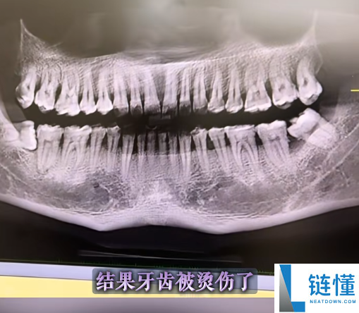 吃烤串烫伤牙齿的真实案例与预防方法