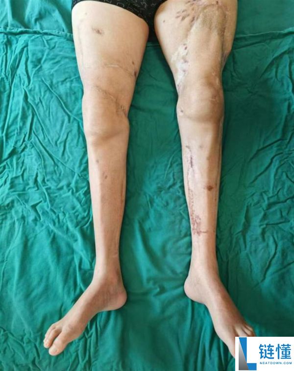 我国成功实施世界首例双大腿再植手术：男子20个月后重获行走能力！