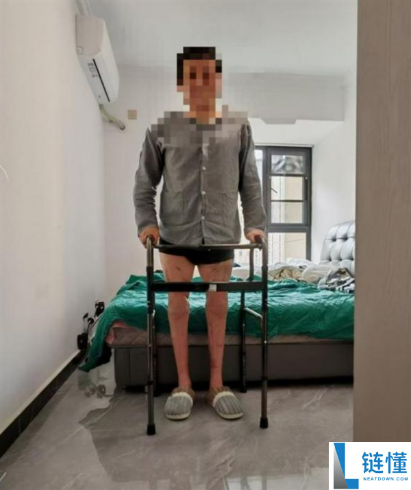我国成功实施世界首例双大腿再植手术：男子20个月后重获行走能力！